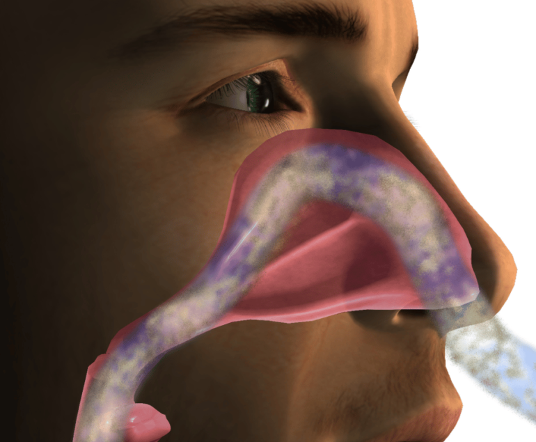 Nasal polyps